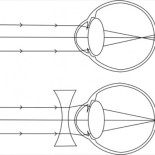 Frenando la miopía: la hipótesis ignorada