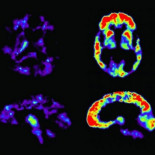 Los fármacos antialzhéimer siguen fracasando y la ciencia ya no sabe qué hacer