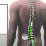 Un dispositivo implantado en la médula permite caminar a un paralítico