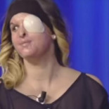 La miss italiana que fue atacada con ácido por su exnovio muestra su rostro desfigurado en TV