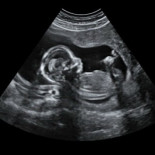 El consumo de alcohol durante el embarazo altera el desarrollo de la cara del bebé