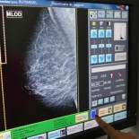 Le diagnostican cáncer por error y, tras una mastectomía y quimioterapia, descubren que estaba sana