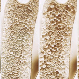 Un paso de gigante contra la osteoporosis