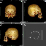 Hallan cráneos con deformación artificial de hace 1.500 años en Europa
