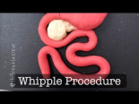 Una duodenopancreatectomía y otras cirugías con plastilina para despetar la curiosidad de los pequeños amantes de la medicina [ENG]