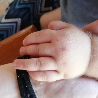 Detectados 11 casos del síndrome del hombre lobo en lactantes cuyos padres usaban lociones contra la calvicie