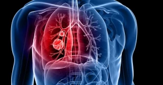 Una mujer muere de cáncer porque su doctora utilizó un “corta y pega” de un TAC anterior para su diagnóstico: sus hijos van a recibir una indemnización de 100.000 euros