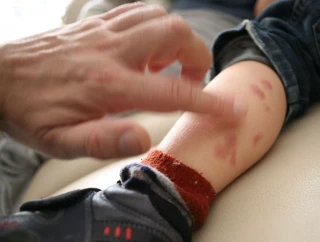 Los casos de sarna en Asturias se disparan por la resistencia a los fármacos