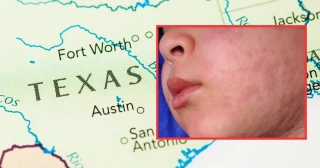 Muere niña de 8 años en Texas por sarampión; suman dos menores fallecidos en EU por el brote