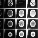 Reino Unido producirá tratamientos de vanguardia contra el cáncer utilizando uranio reprocesado procedente de combustible nuclear gastado (eng)