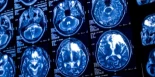 Cuando sobrevivir no es el final: el envejecimiento acelerado del cerebro tras el cáncer infantil