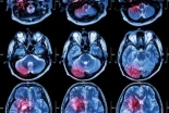 Un estudio pone el foco en la testosterona y su posible papel en el cáncer cerebral en hombres