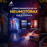 Así de fácil se diagnostica un neumotórax en una ecografía pulmonar