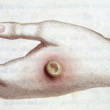 Un adolescente del UK ha contraído  la viruela bovina,  una enfermedad que no es común desde el siglo XVIII [ing]