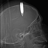 Cirujanos extirpan un proyectil explosivo de la cabeza de un soldado