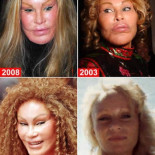 Los diez peores desastres de cirugía estética