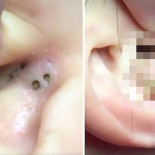 Hay MUCHA gente enganchada a esta extracción de un punto negro en la oreja y nos cuesta entenderlo