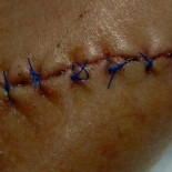 El apuñalado por un aparcacoches en Arrecife: ¿Cómo es posible que al día siguiente quedara libre?