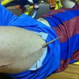 Un jugador de fútbol sala ensartado en una astilla de parqué de medio metro [NSFW]