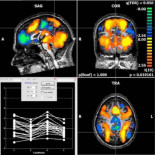 Descubren que el escáner afecta al metabolismo del cerebro
