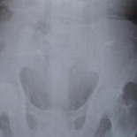 Tenía 100 agujas clavadas por su cuerpo y no lo sabía