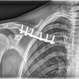 Un nanofenómeno que desencadena el proceso de AUTO-reparación ósea